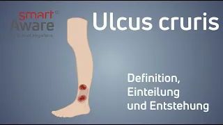 Ulcus cruris: Definition, Einleitung und Entstehung | Wundmanagement in der Pflege | smartAware