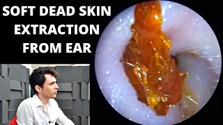 Soft Dead Skin Easily Extracted From Ear Canal