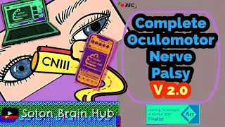 Complete Oculomotor Nerve Palsy