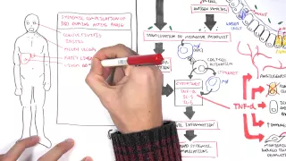 Inflammatory Bowel Disease - Pathophysiology and Complications