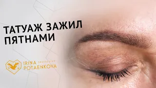 Почему татуаж бровей зажил пятнами? Как исправить?