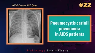 Pneumocystis carinii Pneumonia | Radiology | 1000 videos in 100 days | Radiology Everywhere
