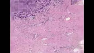 Histopathology Breast --Ductal carcinoma