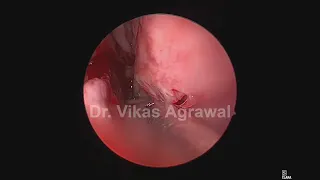 Unedited Endoscopic Septoplasty and turbinoplasty -only for doctors