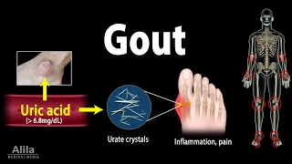 Gout, Pathophysiology, Causes, Symptoms, Risk Factors, Diagnosis and Treatments, Animation.