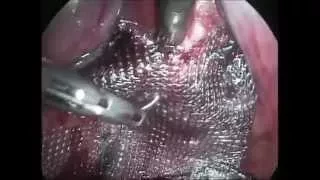 Лапароскопическая апоневротическая mesh-вагинопексия матки при пролапсе