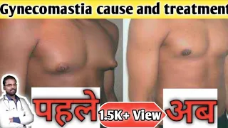 🔥Gynecomastia🔥 का घरेलू इलाज! पुरूष छाती में गांठ का इलाज! Medicine of Gynecomastia !!