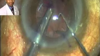 How To Implant Toric IOL in a Small Pupil? by Dr Suresh K Pandey SuVi Eye Inst. Kota, India