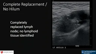 Approach To Axillary Lymph Nodes