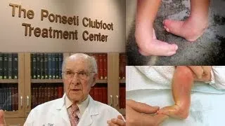 A Walking Miracle - The Ponseti Method for Clubfoot Treatment