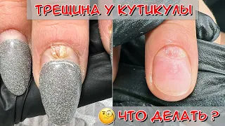 Трещина у кутикулы / Онихорексис - трещина на ногте