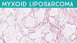 Myxoid liposarcoma, high grade (formerly round cell liposarcoma) AIP France 2021