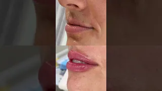 Lip Religion- lip filler technique