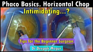 Phaco Basics : Horizontal Chop: What intimidates the Beginner Surgeon. Dr Deepak Megur.