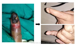 Case of Finger tip Gangrene: Dr Samrat Taori