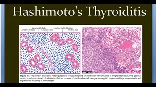 Pathology 811 a Hashimoto Thyroiditis inflammation Thyroid Auto immune CTLA4 PTPN22 Painless