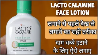 लैक्टो कैलामाइन लोशन |Lacto Calamine Face Lotion | Review in hindi |How to use lacto calamine lotion