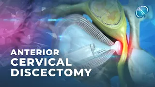 What is Endoscopic Anterior Cervical Discectomy?