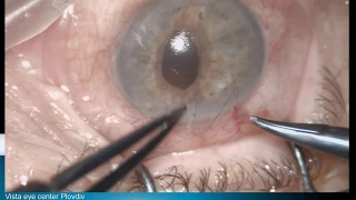 Corneal sutures releasing Lukan Mishev Live Stream