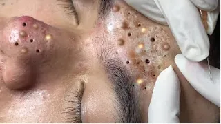 Amazing blackhead treatment by Loan Nguyen Spa #115