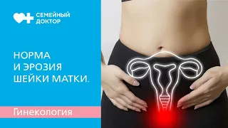 Норма и эрозия шейки матки. Что важно знать женщине.