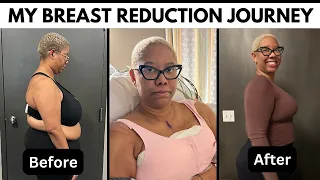 My Breast Reduction Surgery and Recovery Vlog - Answering All Of Your Questions!