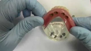 4-Implant Ball Attachment Overdenture - Model Demonstration