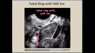 Ectopic Pregnancy by Ultrasound