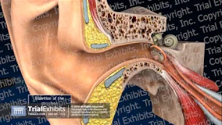 Tympanic Membrane Perforations