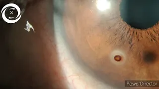 Corneal foreign body and it's Surrounding Rust