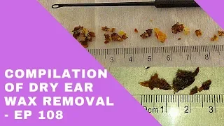 DRY EAR WAX REMOVAL COMPILATION - EP 108
