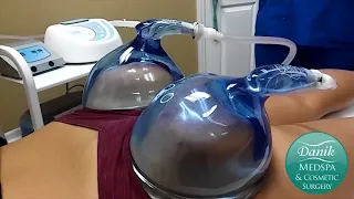 Vacuum Therapy for Butt Lift