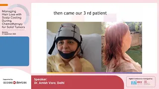 Part 3 - Scalp cooling: Breast Cancer and beyond: An Indian experience - Dr. Amish Vora, Delhi
