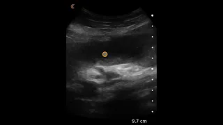 Small Bowel Obstruction - Ultrasound Image Interpretation