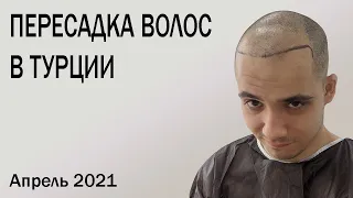 Пересадка волос в Турции в 2021 году. Мой опыт.