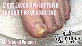 👣Most Extreme Ingrown Toenail Salon Pedicure - Shortened 👣