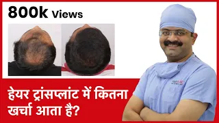 What Is The Cost Of Hair Transplant In India (हेयर ट्रांसप्लांट में कितना खर्चा आता है) | (In HINDI)