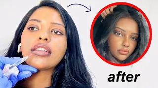 how a little filler changed my WHOLE face (fixing botched lips)