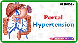 Portal hypertension USMLE Step 1 : Etiology, Clinical features, Diagnosis and Treatment