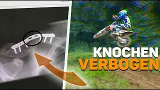 Wegen CRASH mein KNOCHEN verbogen | DJMV Flehingen | MXvlog