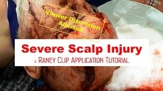Severe Scalp Injury and Raney Clip Application (Viewer Discretion Advised)
