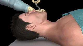 Oral airway insertion - oropharyngeal airway technique - 3D animation