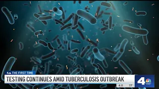 Half of tuberculosis cases in Long Beach linked to homeless housing