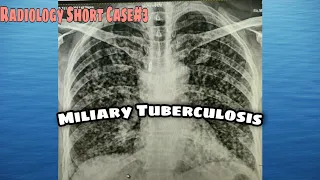 Miliary Tuberculosis-- Radiology short case