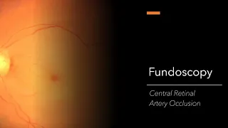 Central Retinal Artery Occlusion (CRAO): Fundoscopy