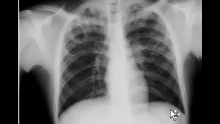 Chest x-ray - Tuberculosis