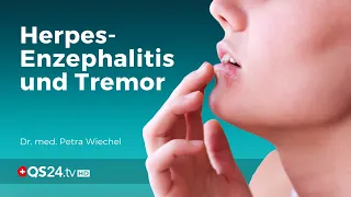 Herpes-Enzephalitis und Tremor  | Dr. med. Petra Wiechel | Visite | QS24 Gesundheitsfernsehen