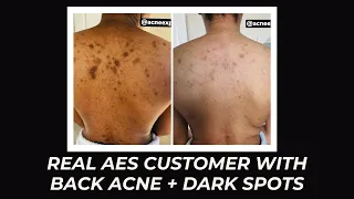 REAL AES CUSTOMER WITH BACK ACNE + DARK SPOTS
