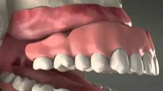 Implant supported Upper Denture