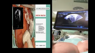 ECHOCARDIOGRAPHIC EVALUATION OF HEMODYNAMICS IN NEONATES (PART 3/5). LEFT VENTRICLE FUNCTION.